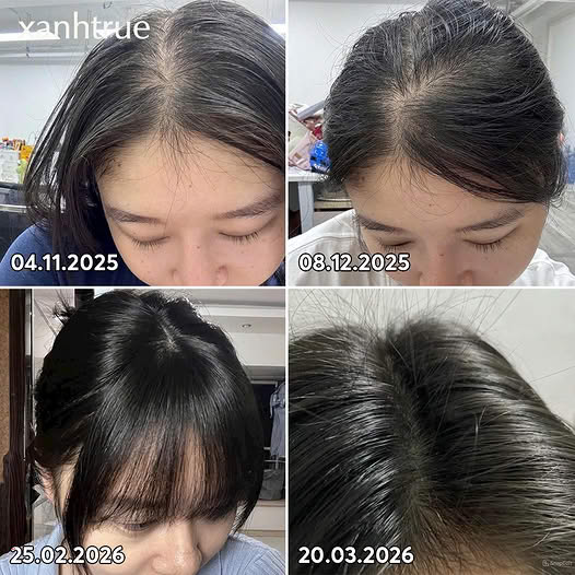 Timeline tóc mọc 4 tháng - xanhtrue